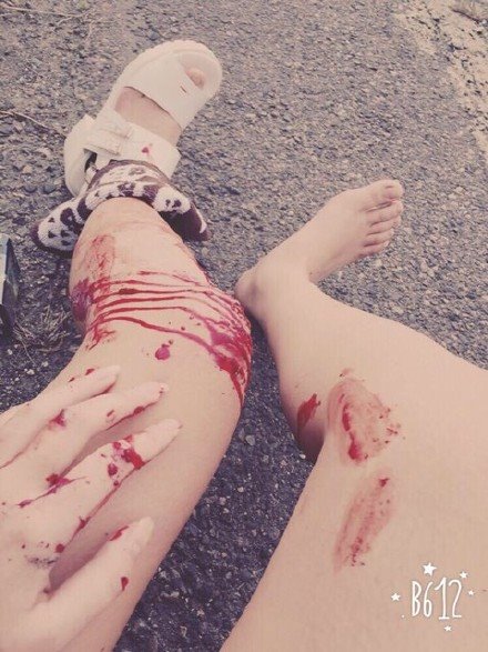 岛国妹子网络蹿红车祸醒来发自拍不忘磨皮